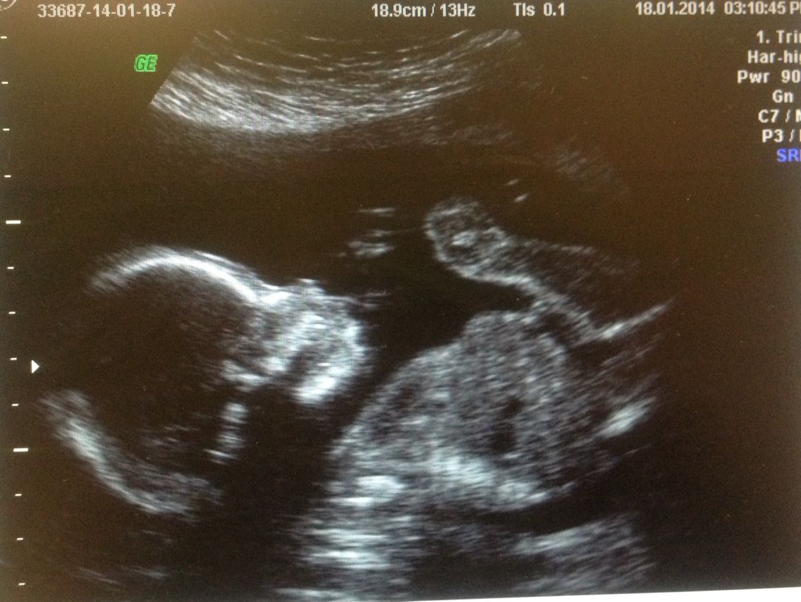 7 Months Ultrasound Boy