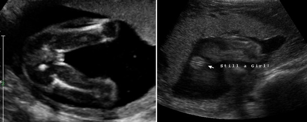 24 Week Ultrasound Girl