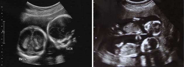17 weeks ultrasound twins pictures