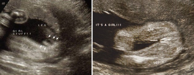 33 Week Ultrasound Girl