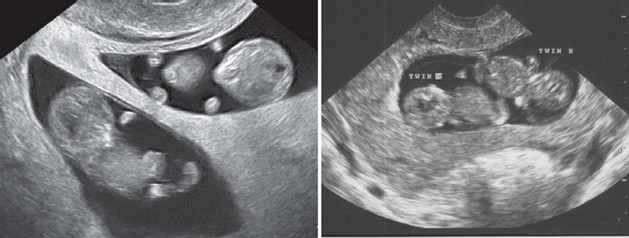 10 weeks ultrasound twins pictures