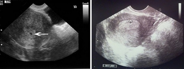 Weeks 2 sonogram at Fetal ultrasound