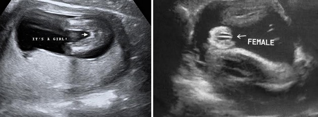 34 Week Ultrasound Girl