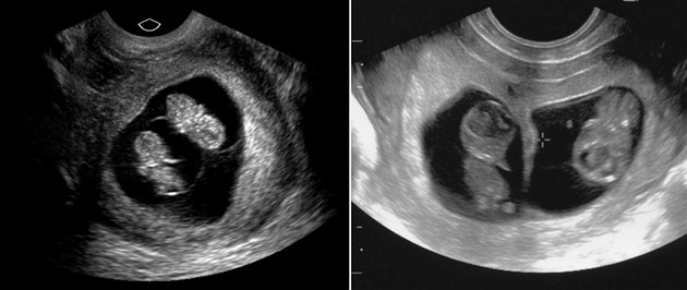 9 weeks ultrasound twins pictures