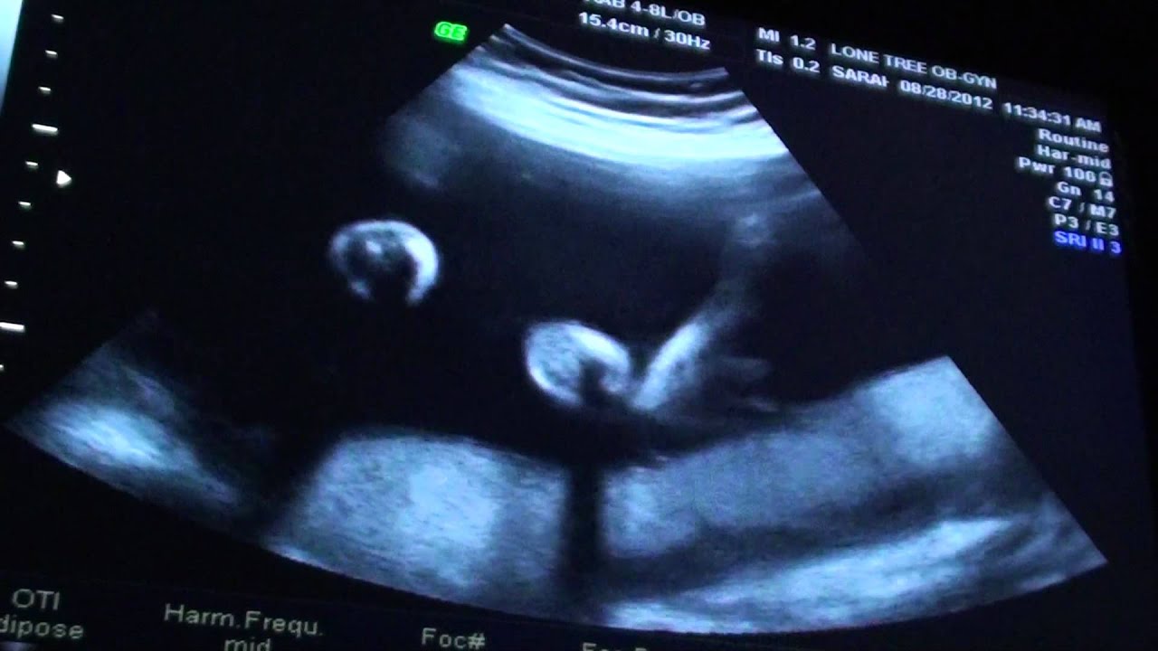 26 weeks ultrasound twins pictures
