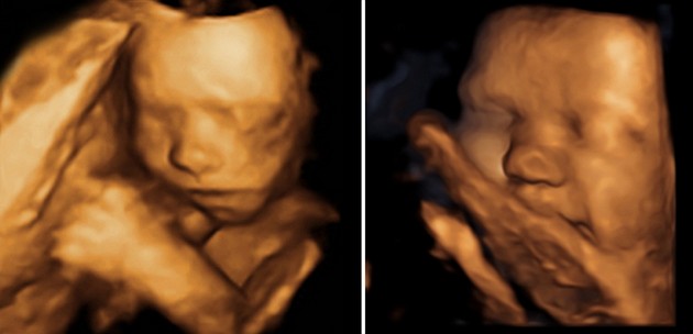 Ultrasound at 40 Weeks Pregnant