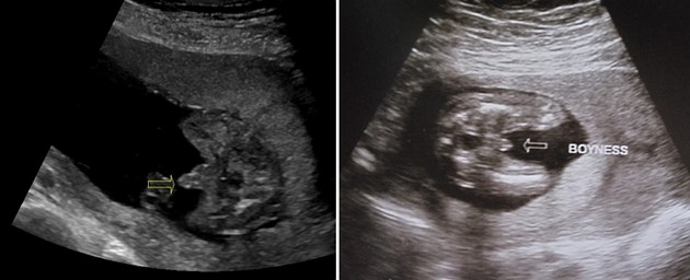 19 Week Ultrasound Boy
