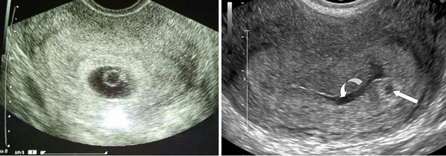 1 week ultrasound photo