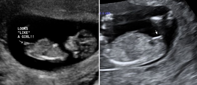 12 Week Ultrasound Girl