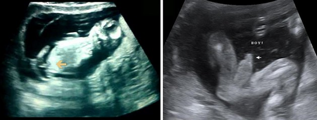 13 Week Ultrasound Boy