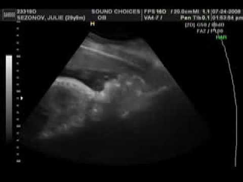 33 Week Ultrasound Boy