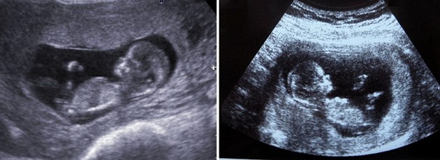 11 weeks ultrasound photo