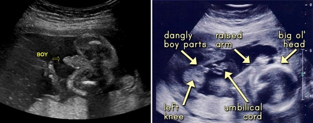 22 Week Ultrasound Boy
