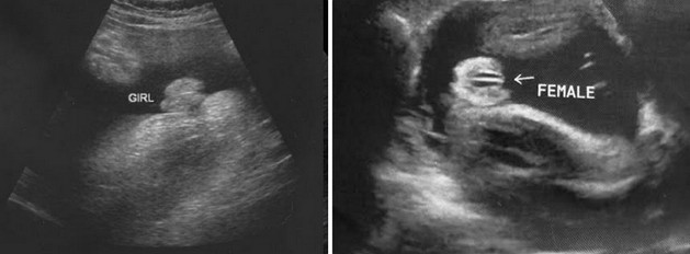 36 Week Ultrasound Girl