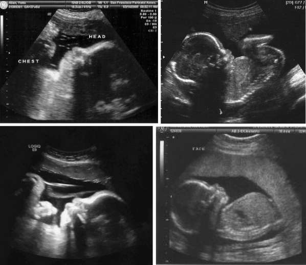 ultrasound at 9 months pregnant