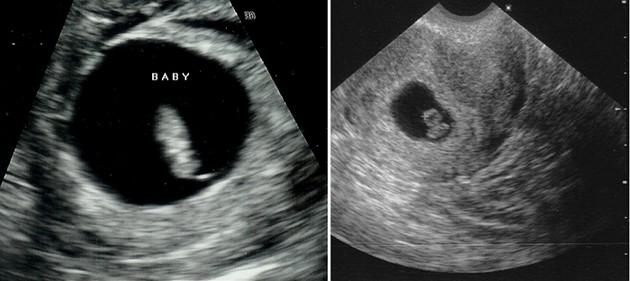 7 weeks ultrasound photo