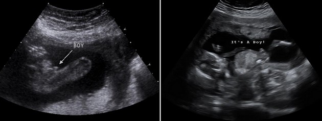 14 Week Ultrasound Boy