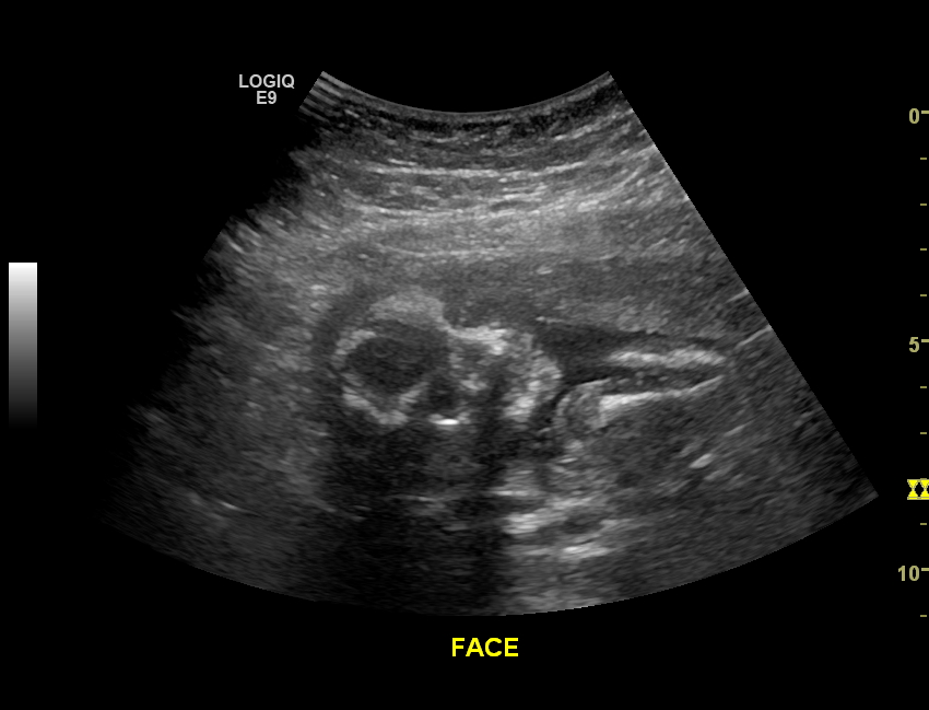 4 Months Ultrasound Boy