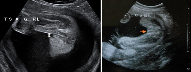 25 Week Ultrasound Girl