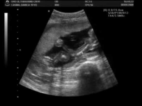 4 Months Ultrasound Girl