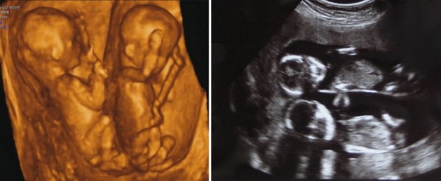 22 weeks ultrasound twins pictures