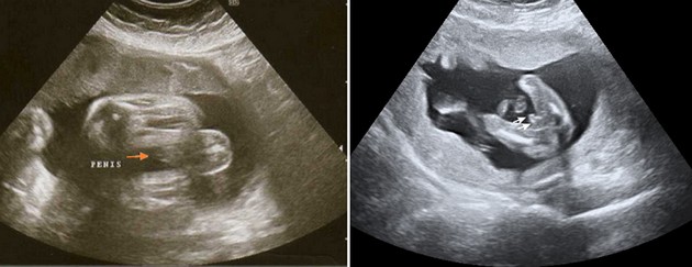 36 Week Ultrasound Boy