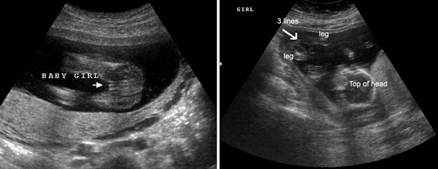 16 Week Ultrasound Girl