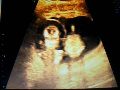 ultrasound of twins at 3 months