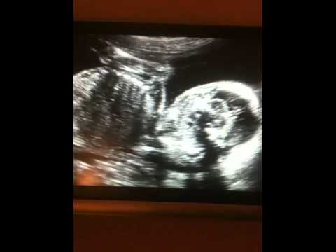 ultrasound of twins at 5 months
