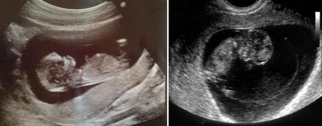 10 weeks ultrasound photo