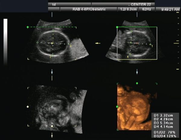 How Soon Can an Ultrasound Detect Pregnancy