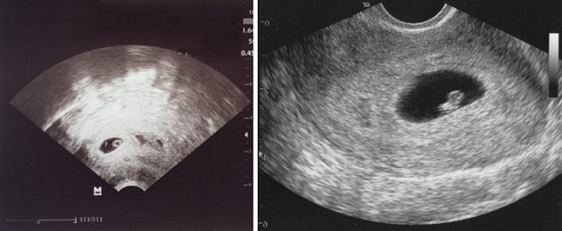 6 weeks ultrasound photo