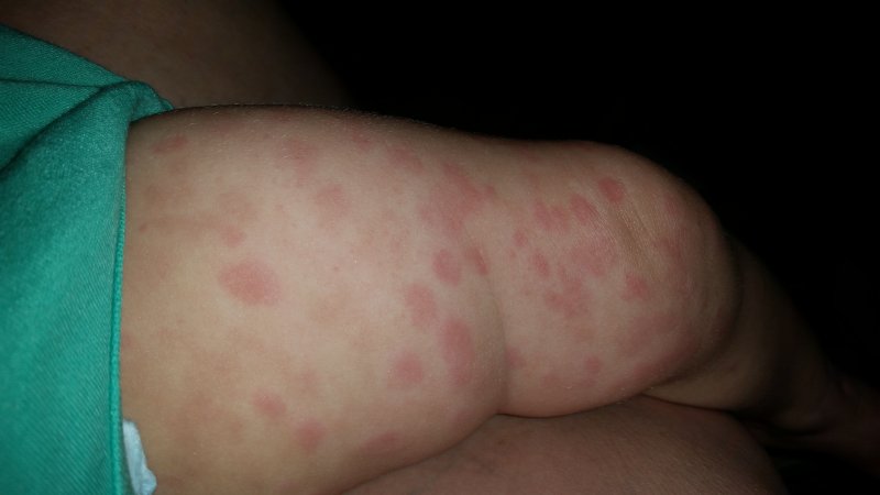 baby rash on legs mycoses